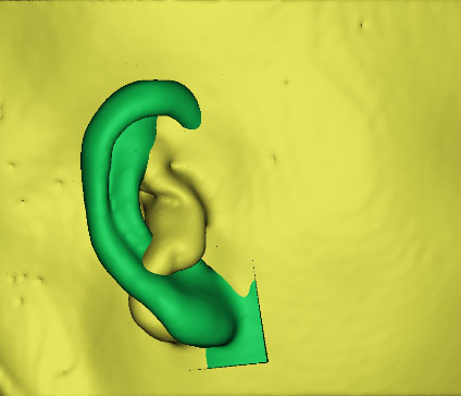 小耳畸形怎么辦？這有一份三維數(shù)字化治療方案請(qǐng)簽收！